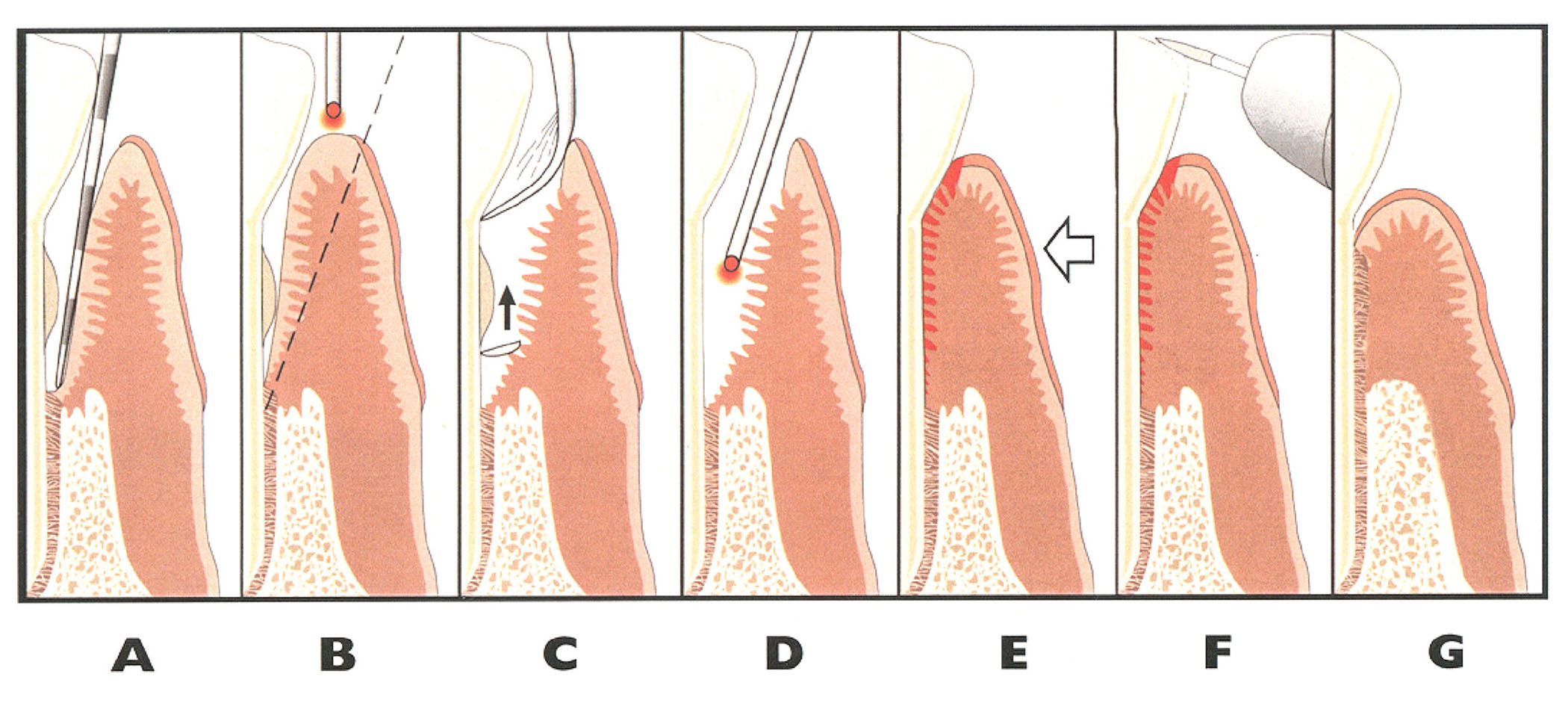 How LASER treatment can help with Periodontitis